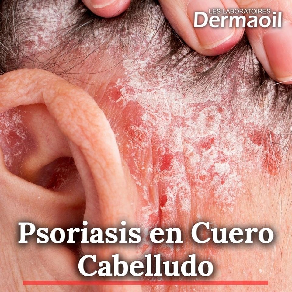 Psoriasis del Cuero Cabelludo: Causas, Síntomas y Tratamiento - H&S ES