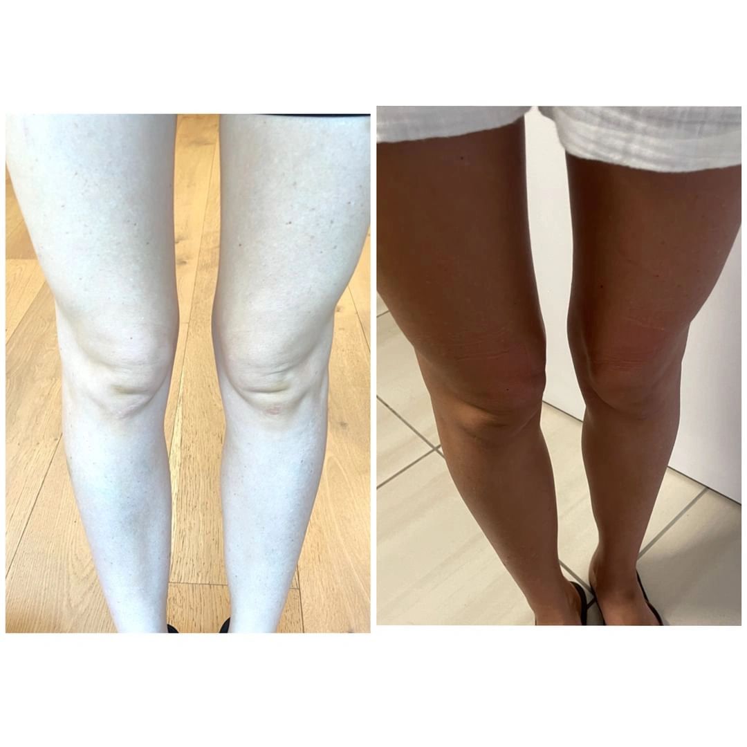 melanotan 2 vorher nachher (@melanotanii)  Facebook Melanotan tanning injections | PPTX