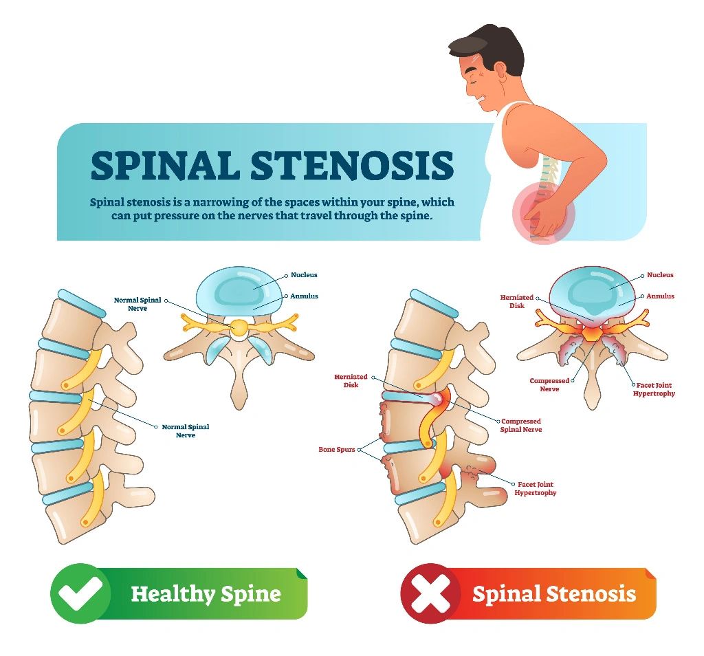 Radiant Physiotherapy Clinic: Spinal Stenosis Options: How to