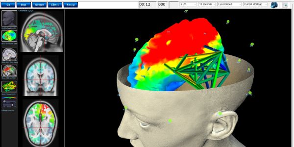 3D brain connectivity and 3D sLORETA source localization activity in neuroimaging software.