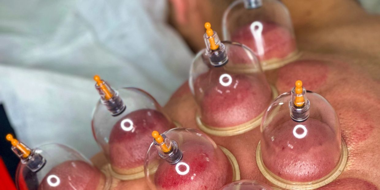Dry Cupping & Hijama on clients shoulder.
