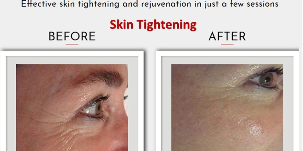 SkinTight: An Effective Skin Tightening Treatment