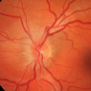retina neuro-ophthalmologist optic nerve papilledema pseudotumor glaucoma macular degeneration 