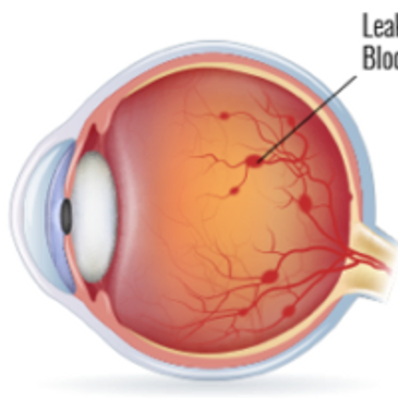 diabetes diabetic retinopathy macular edema diabetic eye disease retina retinal specialist 