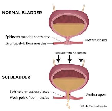 Bladder leakage with sneezing, laughing, jumping or activity?