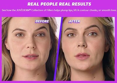 The smart Trick of How Long Does Juvederm Last? All Products Covered That Nobody is Talking AboutEverything about How Long Does Juvederm Last? A Top Cosmetic Surgeon ... thumbnail