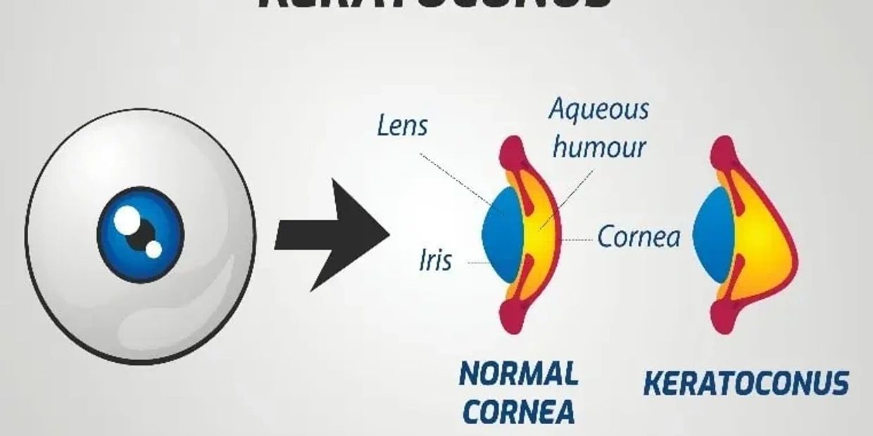 Keratoconus Treatment - Dr Wachler 424-478-9157