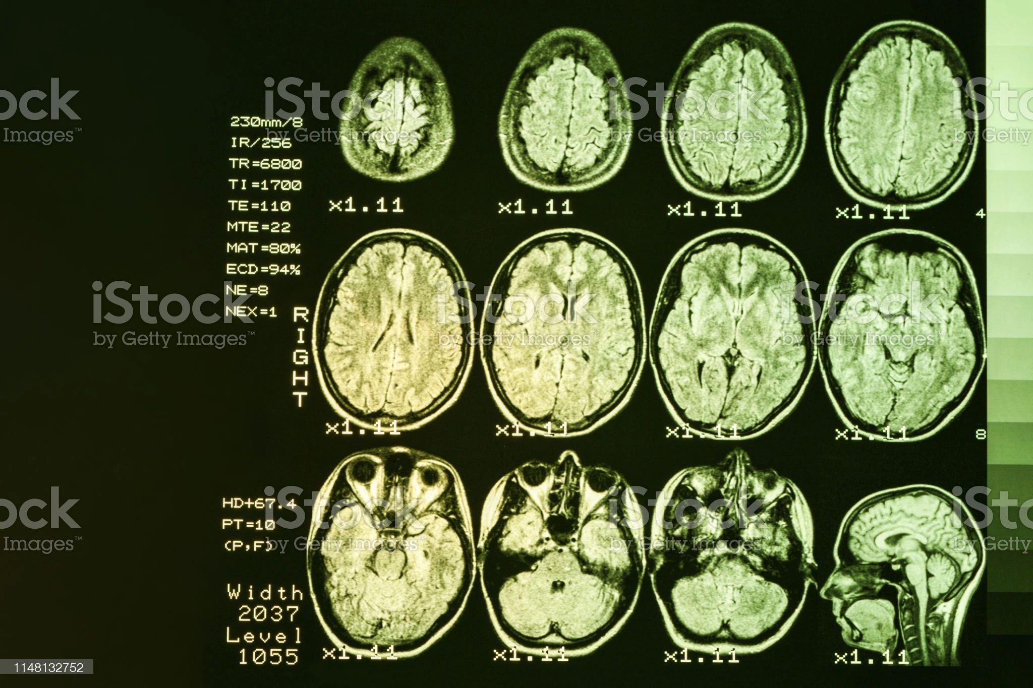 Явление полушарной асимметрии мозга. Дилатация боковых желудочков головного мозга. Асимметрия боковых желудочков мрт. Асимметрия боковых желудочков головного мозга показатели. Мрт асимметрии мозга.