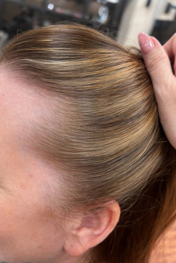 Woman showing a receding hairline with hand holding hair back.
