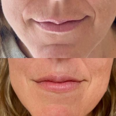 Lip Filler Portland, maine