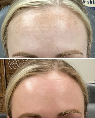 before and after of a forehead from a pico laser treatment 