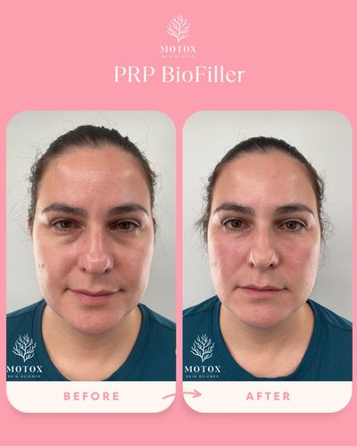 Undereye biofiller results. 