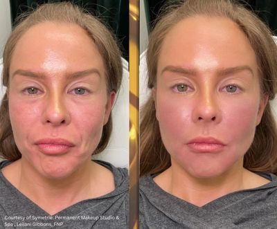 prf ez gel in portland maine. cellenis derma portland maine