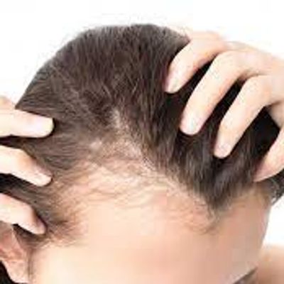 PRP hair injections for thinning hair