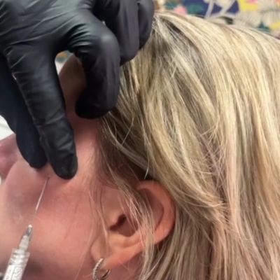 Radiesse Biostimulators Sculptra Portland Maine
