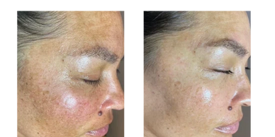 Chemical peel beofre & after