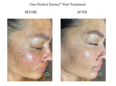 Chemical peel before & after