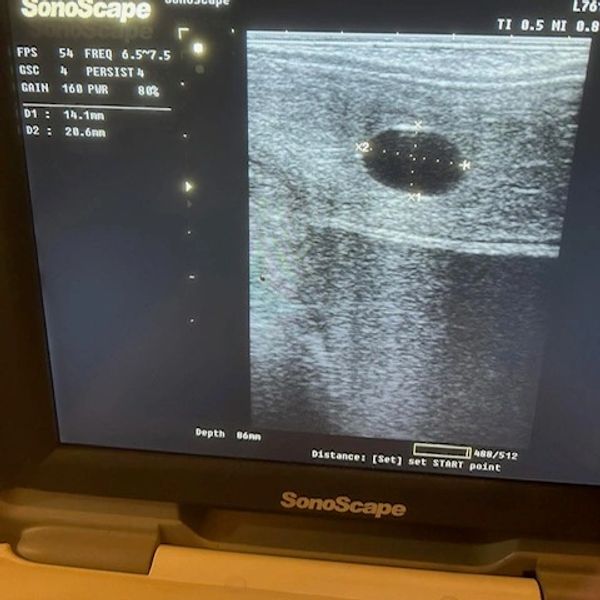 Ultrasound image showing a circular dark area with measurements on a SonoScape machine.