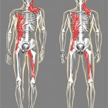 Two human skeletal diagrams highlighting red areas along the left side.