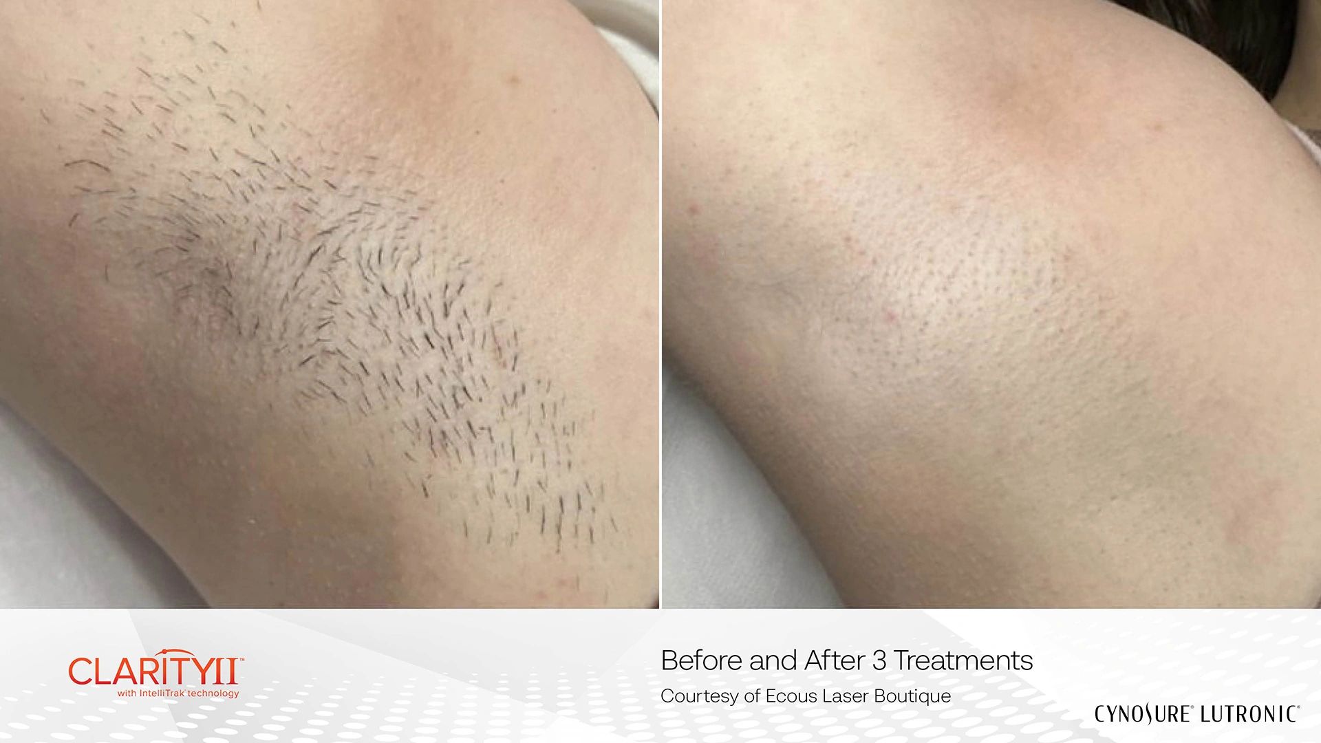 Before and after Underarm