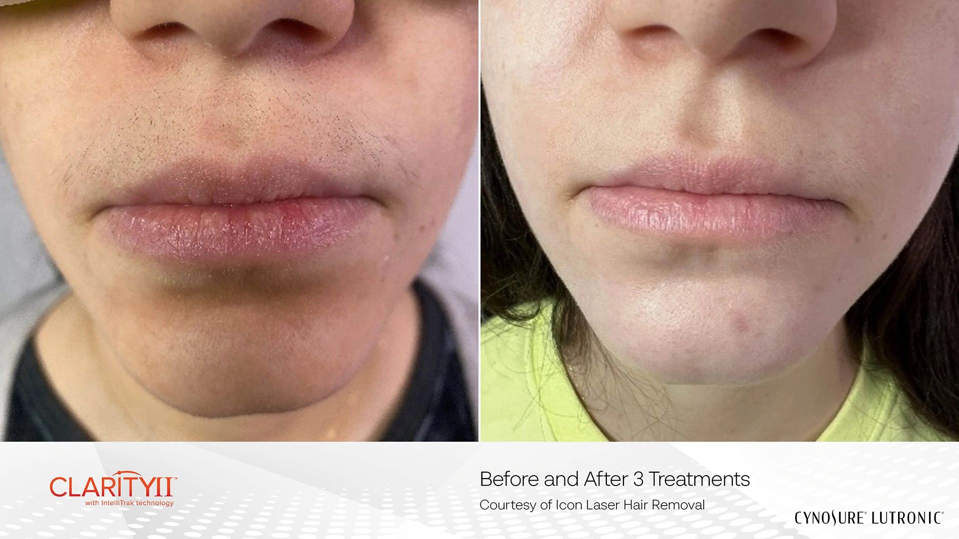 Before and after Upper Lip