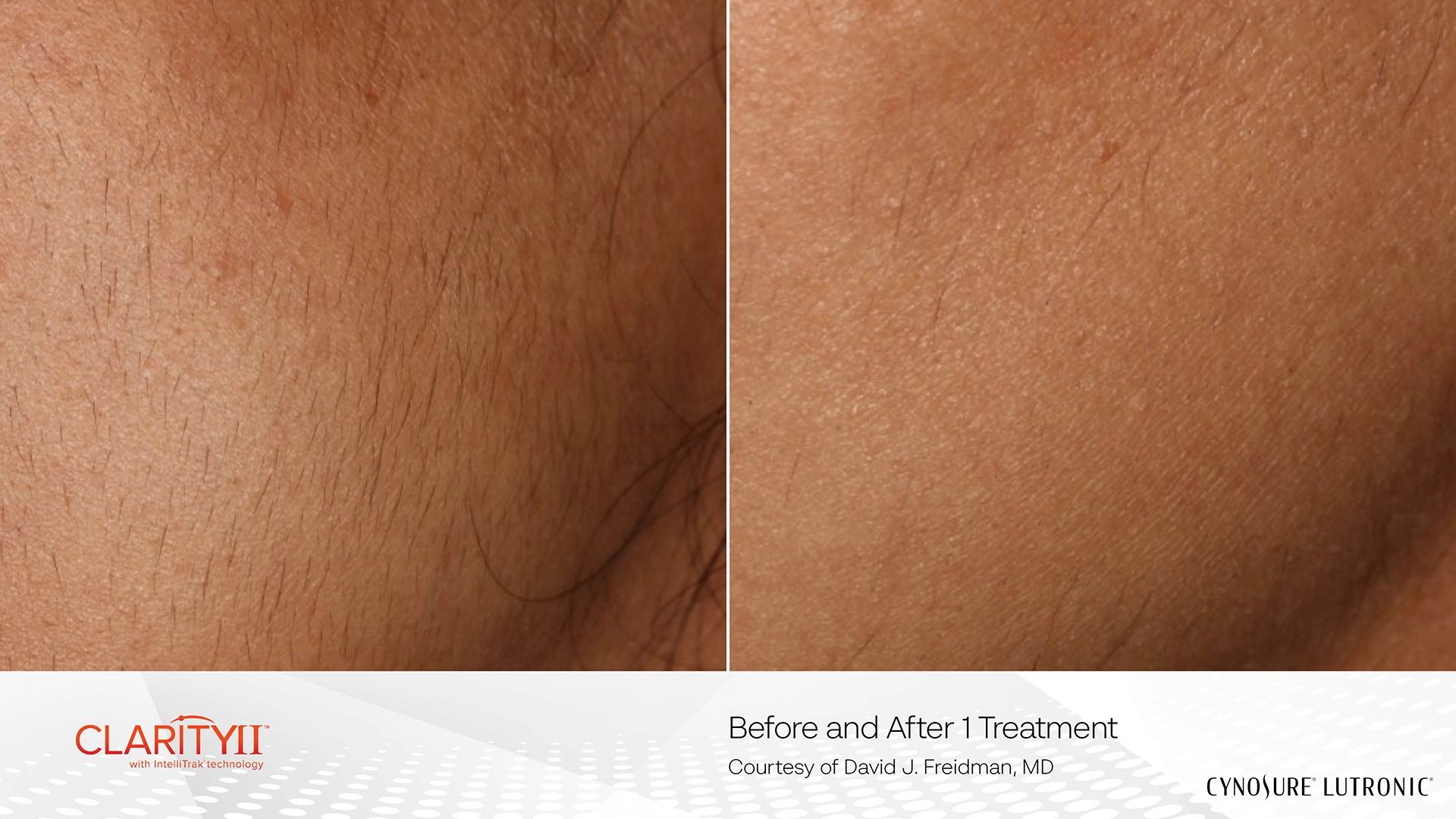 Before and after Cheek
