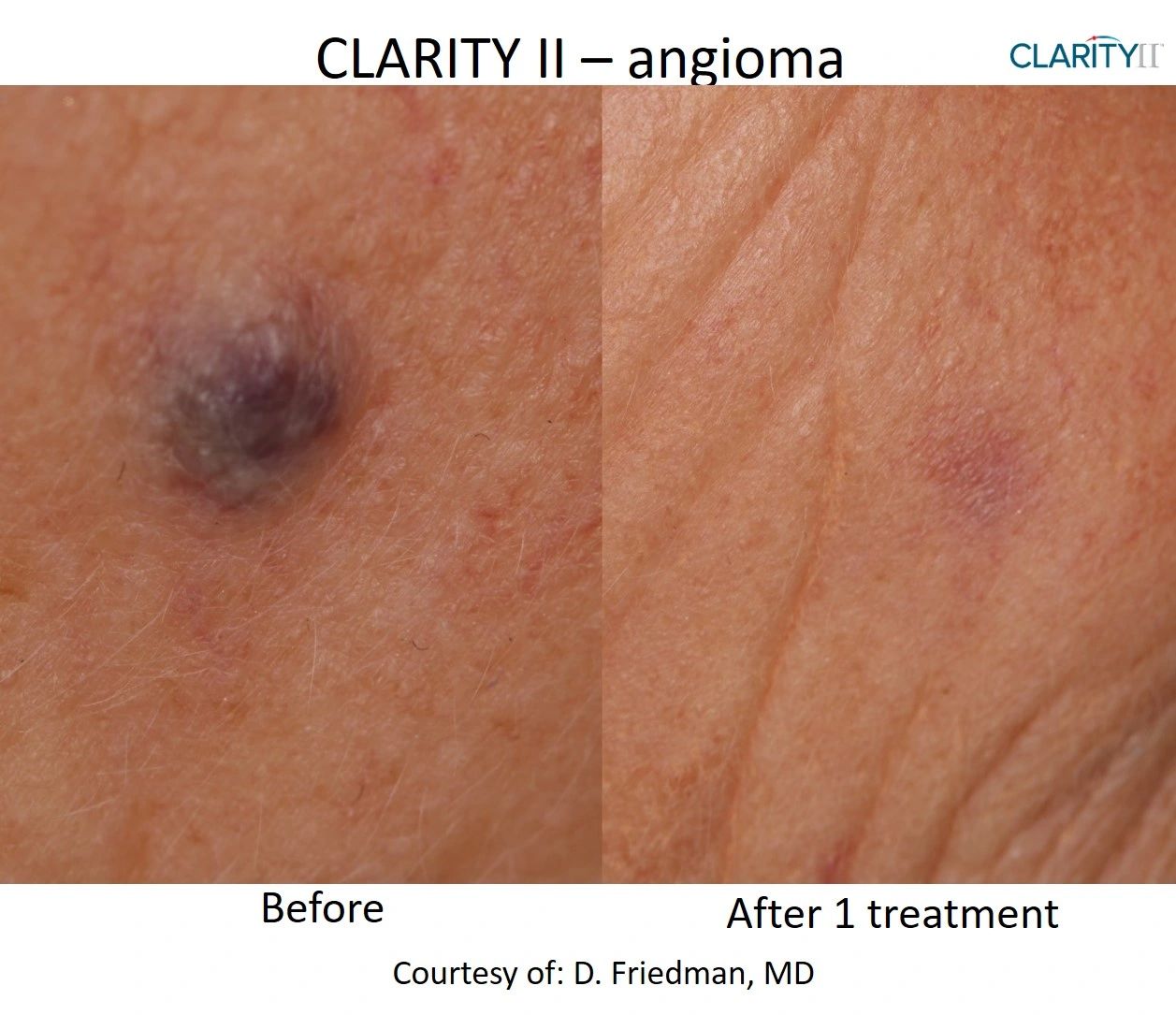 Before and after Skin Revitalization