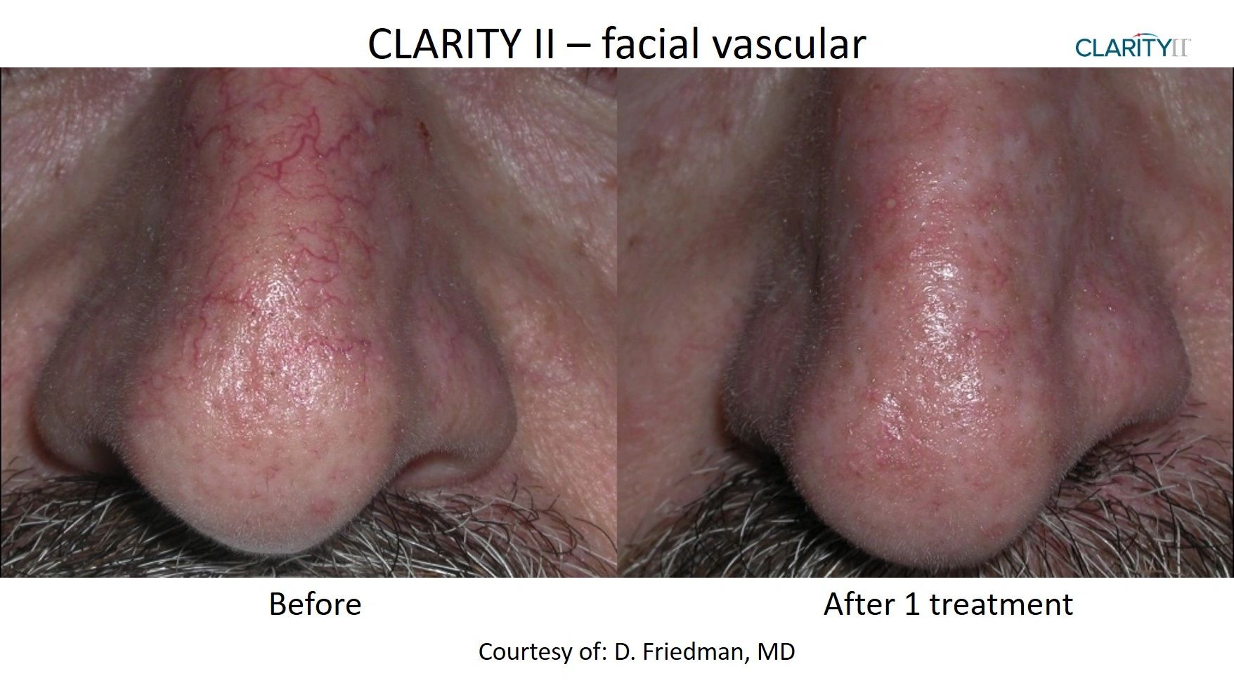 Before and after Vein Removal