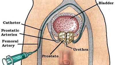 Yale Medicine - Prostatic Artery Embolization to Treat an Enlarged Prostate