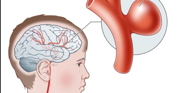 Intra > Procedures and treatments > Interventional radiology > Urological  IR > Varicocele embolisation