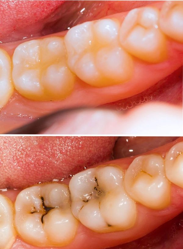 Close-up of healthy molars above and molars with cavities below in a mouth.
