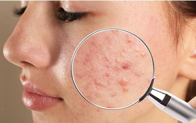 Acne treatment