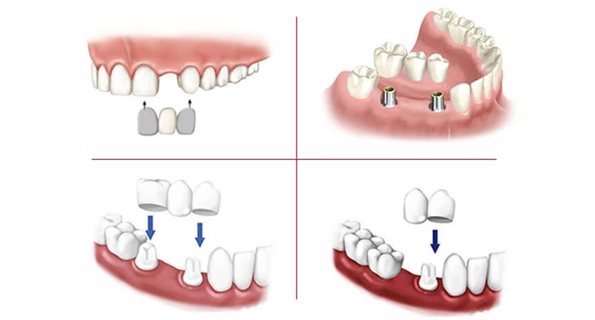 Types Of Dental Bridges