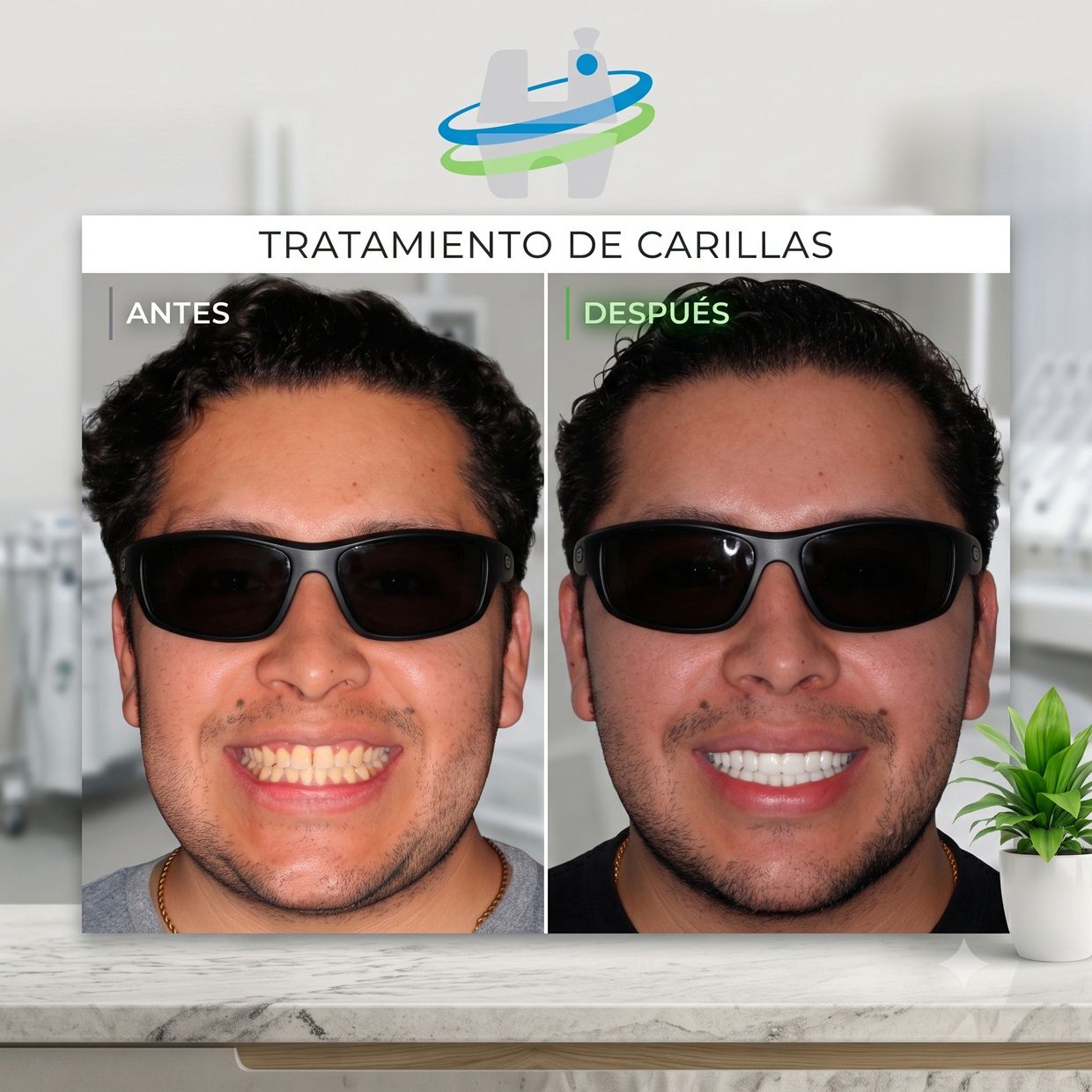 Transformación con carillas dentales antes y después.