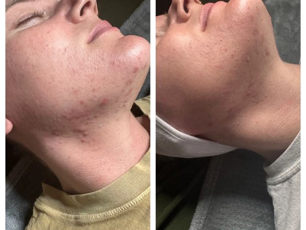 One week difference with one of our chemical peel treatments.