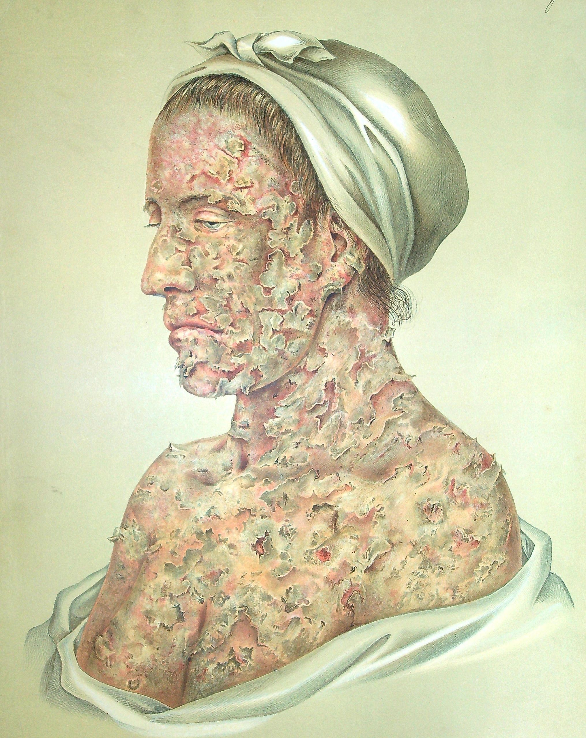 Von Hebra's Atlas der Hautkrankheiten (1856-1876) Von Hebra's Atlas der Hautkrankheiten (1856-1876)