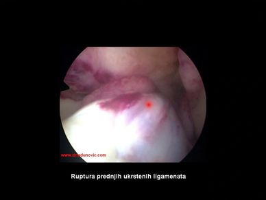 Artroskopija rupture prednjeg ukrštenog ligamenta (LCA ACL)
