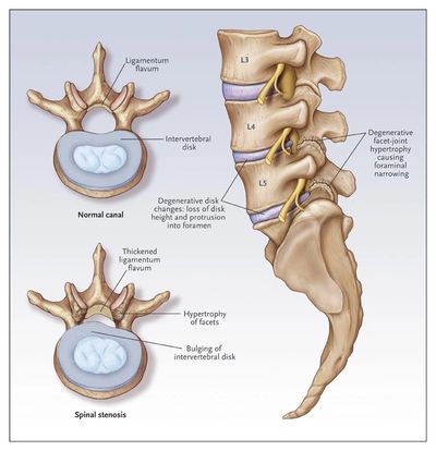 What Causes Spinal Stenosis?