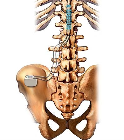 🥇 NYC Spinal Cord Stimulation SCS
