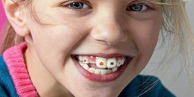 Invisalign first