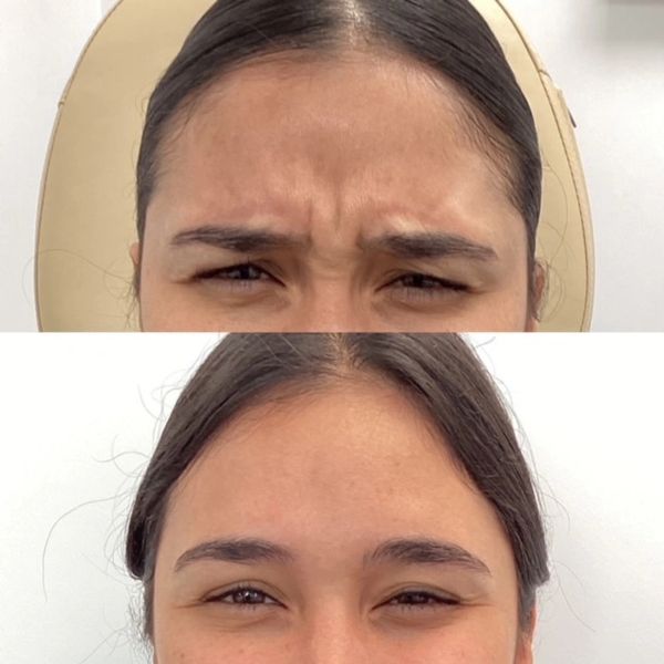 before and after of wrinkle relaxers working at royal aesthetics Phoenix AZ