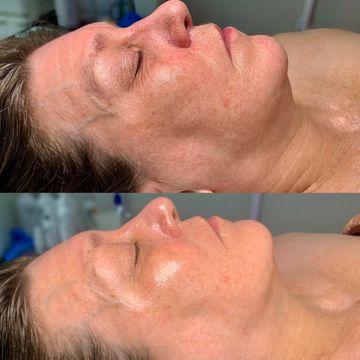 Faux-tox Botox facial