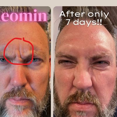Before and after Xeomin injections showing reduction in frown lines after 7 days in Vancouver, WA 
