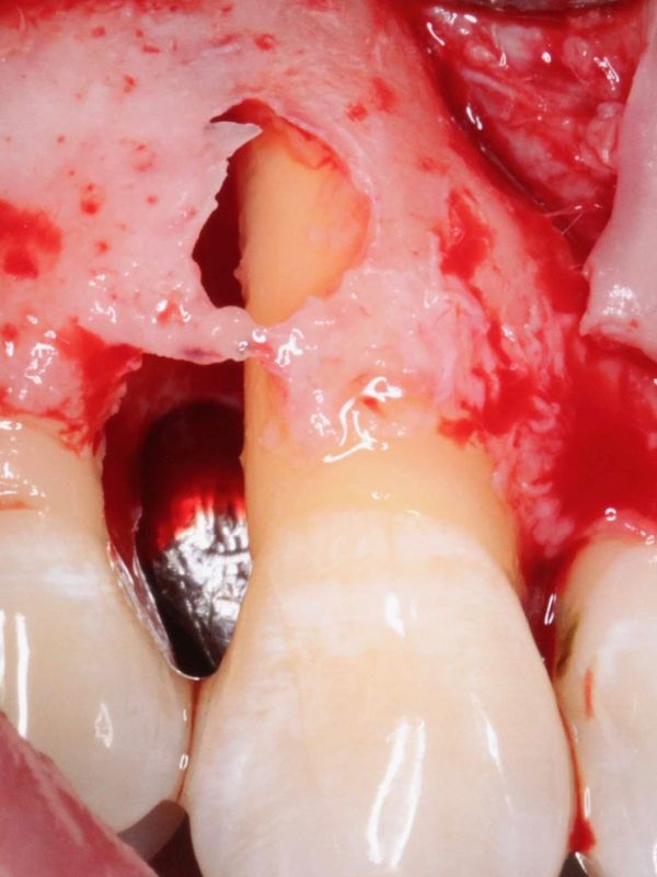Bone loss around a tooth