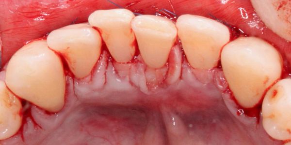 Gum grafting around teeth