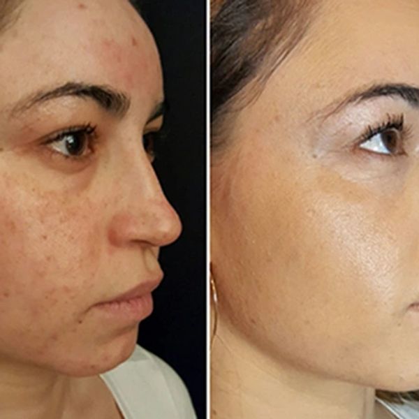 Before and after results of PRP & PRF treatments to aid in the healing of acne.