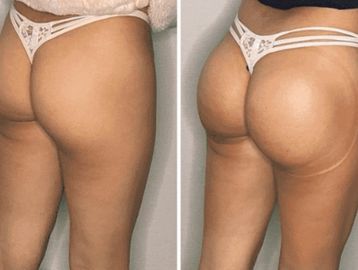 Vacuum Butt Lift – Beauty Factory Boutique Spa