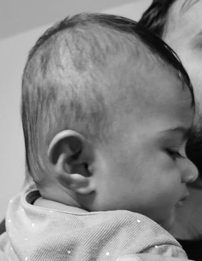 Deformational plagiocephaly - Flat head syndrome