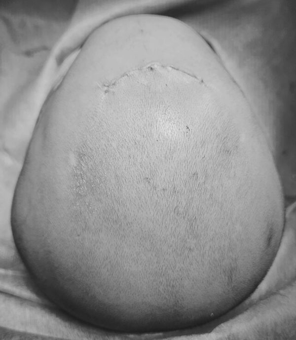Incision for Endoscopic Craniosynostosis surgery