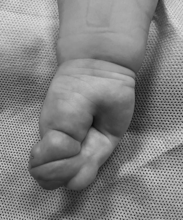 Pfeiffer syndrome